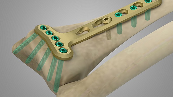 mindray-orthopaedics distributor-trauma-pc